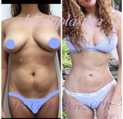 Antes y después de Lipoescultura