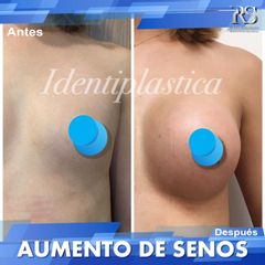 Antes y después de Aumento de busto