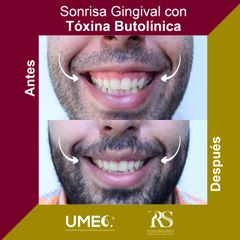 Antes y después de Bótox para sonrisa gingival
