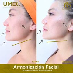 Antes y después de Armonización facial