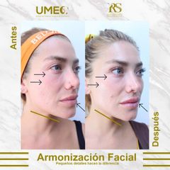 Antes y después de Armonización facial 