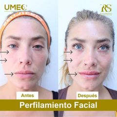 Antes y después de Armonización facial