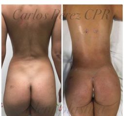 Antes y después de Lipo más transferencia a glúteos