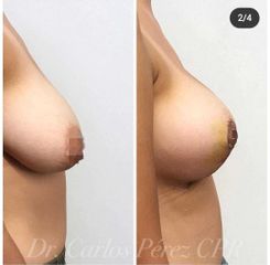 Antes y después de Mastopexia