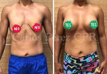 Antes y después de Aumento de mamas