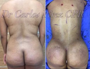 Antes y después de Lipoescultura