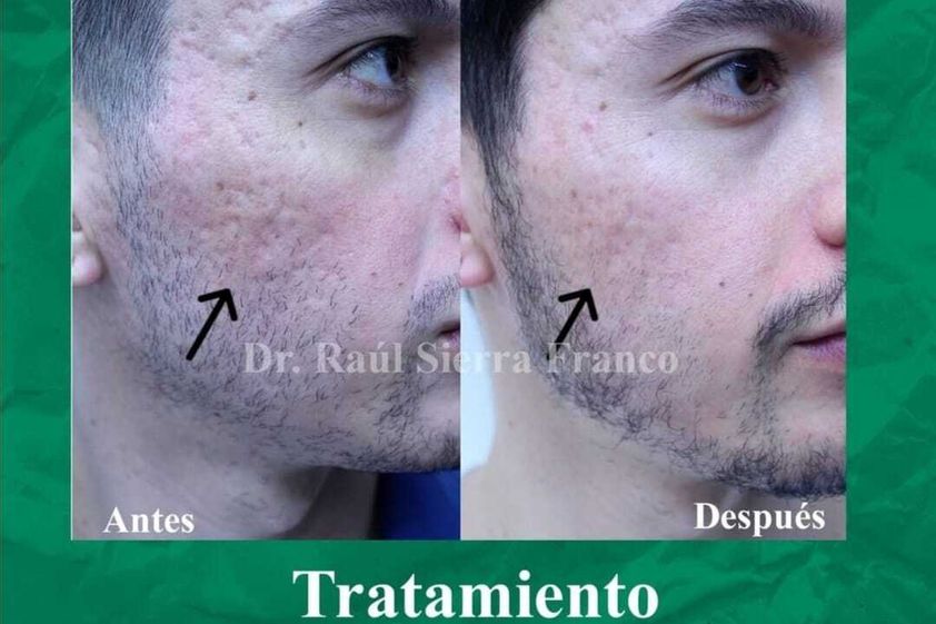 Láser CO2 Fraccionado antes y después - 741122