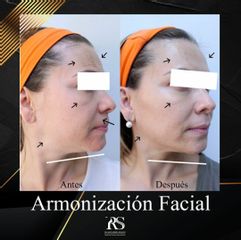 Antes y después de Armonización facial 