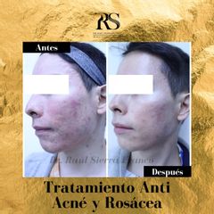 Tratamiento Anti Acné y Rosácea - Dr. Raúl Sierra Franco