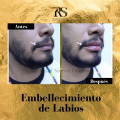Aumento de labios - Dr. Raúl Sierra Franco