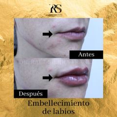 Aumento de labios - Dr. Raúl Sierra Franco
