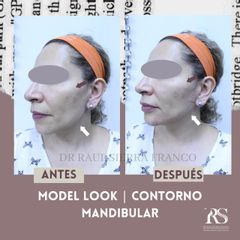 Contorno Mandibular - Dr. Raúl Sierra Franco