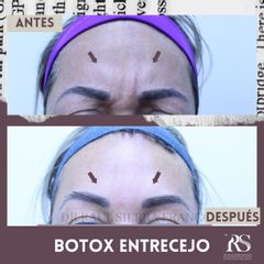 Toxina Botulínica  - Dr. Raúl Sierra Franco