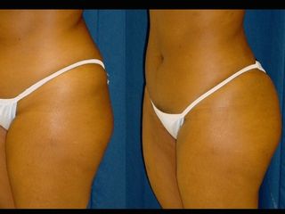 Antes y después de Lipoescultura