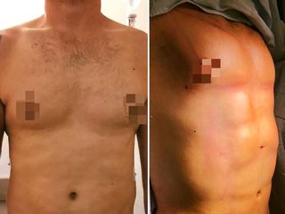 Antes y después de Lipo de alta definición smartlipo
