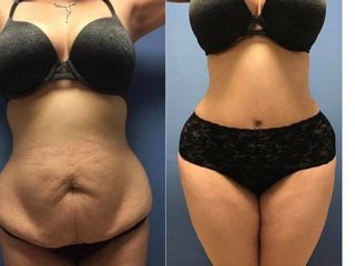 Antes y después de lipoabdominoplastia