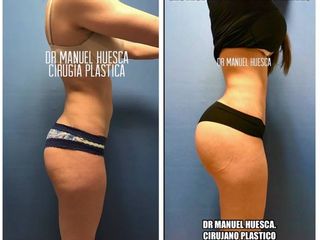Antes y después de Gluteoplastia con implantes 
