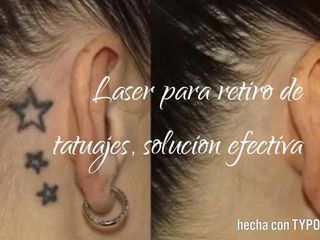 Antes y después de Láser para retiro de tatuajes