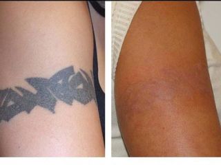 Antes y después de Láser para retiro de tatuajes