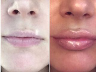 Antes y después de Aumento de labios