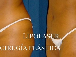 Antes y después de Lipolaser
