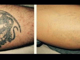 Antes y después de eliminación de tatuajes