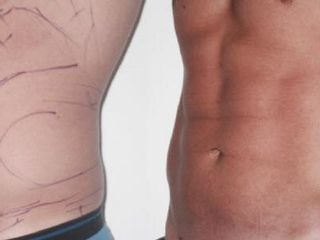 Antes y después de lipo de alta definición