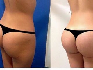 Antes y después de aumento de glúteos