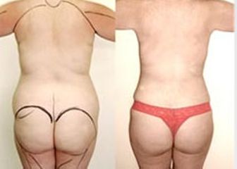Antes y después de Lipoescultura