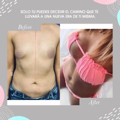 Aumento de busto - Dr. Isaac Baley Spindel | Dr. Mauricio Baley Spindel