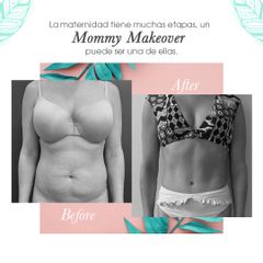 Mommy makeover - Dr. Isaac Baley Spindel | Dr. Mauricio Baley Spindel