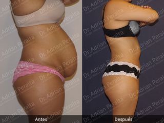 Antes y después de Abdominoplastia