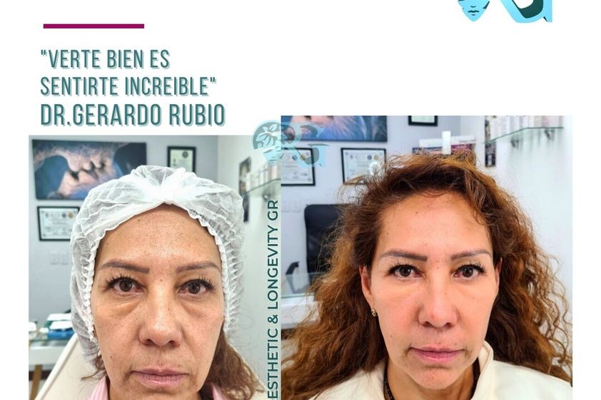 Rejuvenecimiento facial antes y después - 865829
