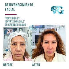 Rejuvenecimiento Facial - Dr. Gerardo Rubio