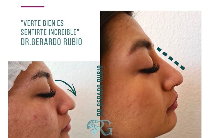 Rinomodelación antes y después - 865830
