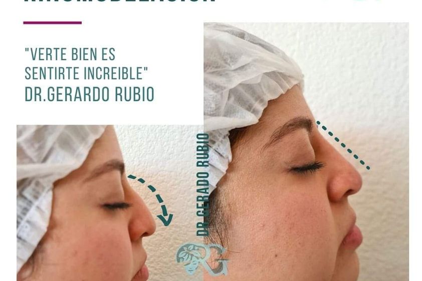 Rinomodelación antes y después - 865831