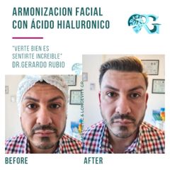 Armonización Facial - Dr. Gerardo Rubio