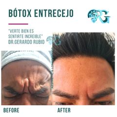Bótox Entecejo - Dr. Gerardo Rubio