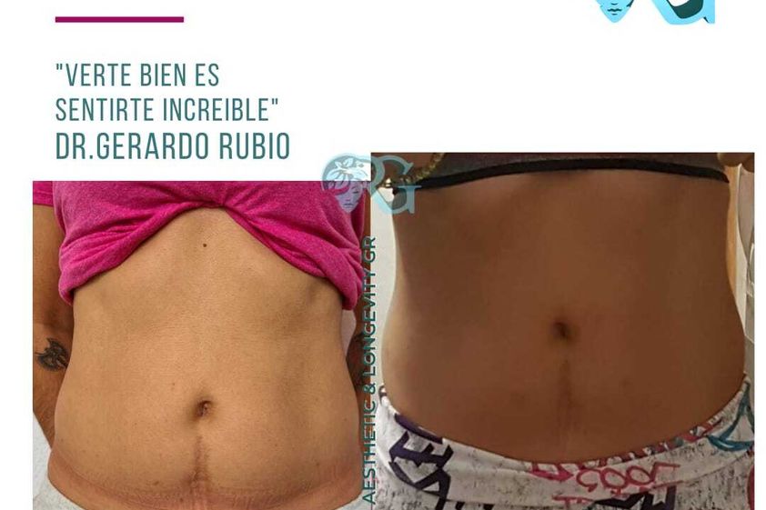 Cavitación antes y después - 865836