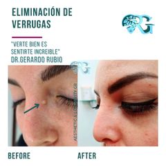 Eliminación de Verrugas - Dr. Gerardo Rubio
