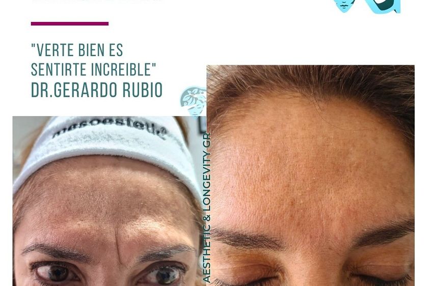 Ácido hialurónico antes y después - 866283