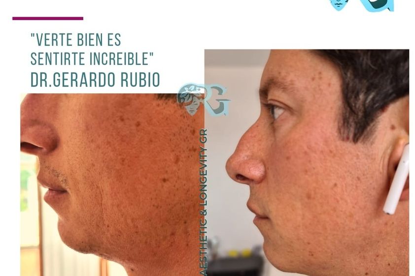Cirugía de papada antes y después - 866285