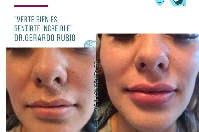 Aumento de labios antes y después - 866287