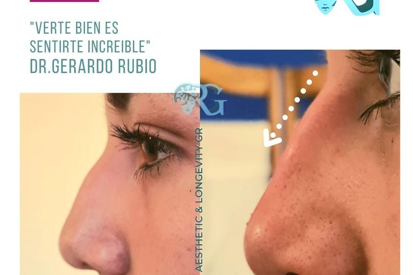 Rinomodelación antes y después - 866289