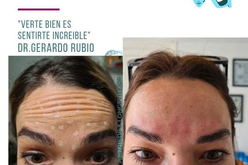 Toxina botulínica antes y después - 867140