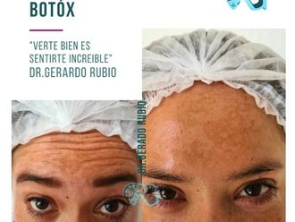 Toxina botulínica antes y después - 867145