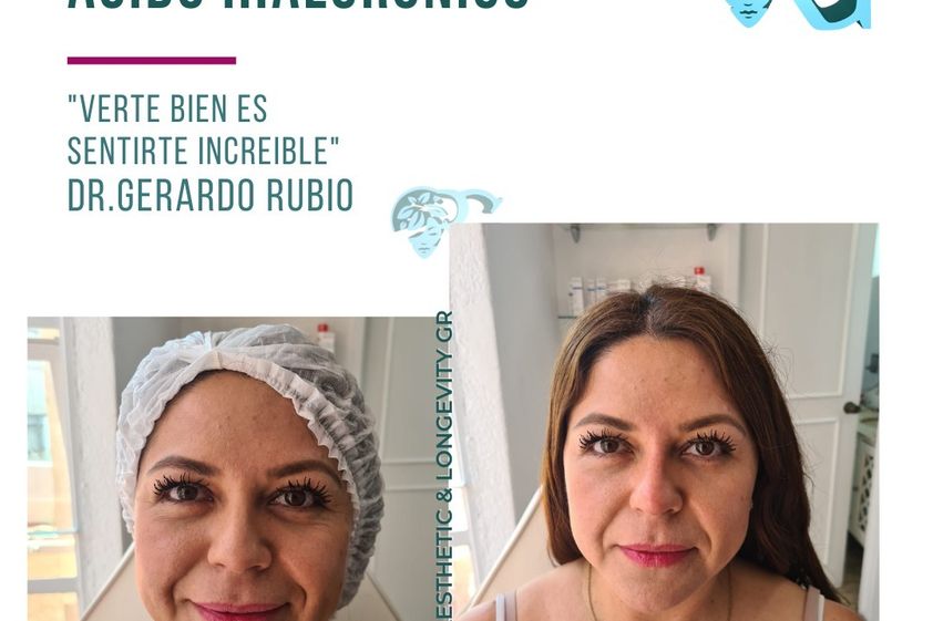 Toxina botulínica antes y después - 867146