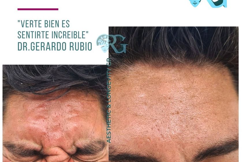 Manchas en la Piel antes y después - 867154