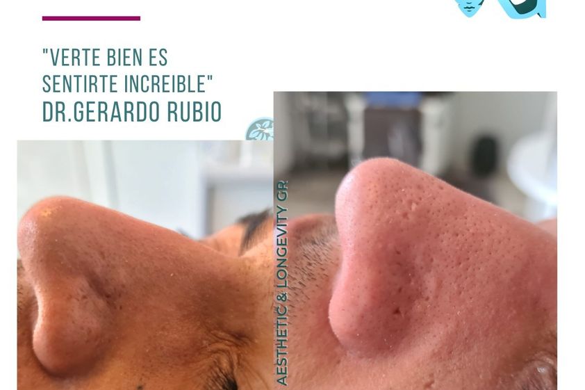 Tratamientos faciales antes y después - 867155