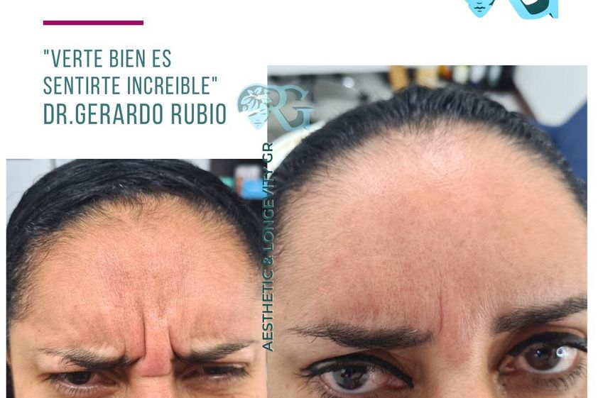 Tratamientos faciales antes y después - 867156